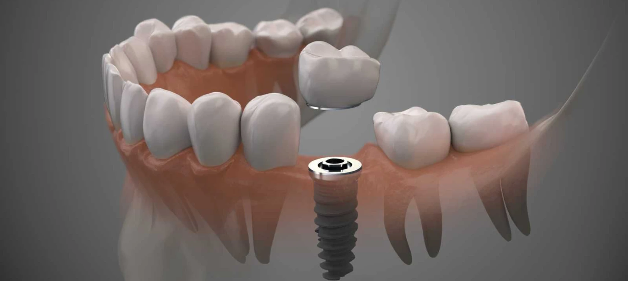 Implants