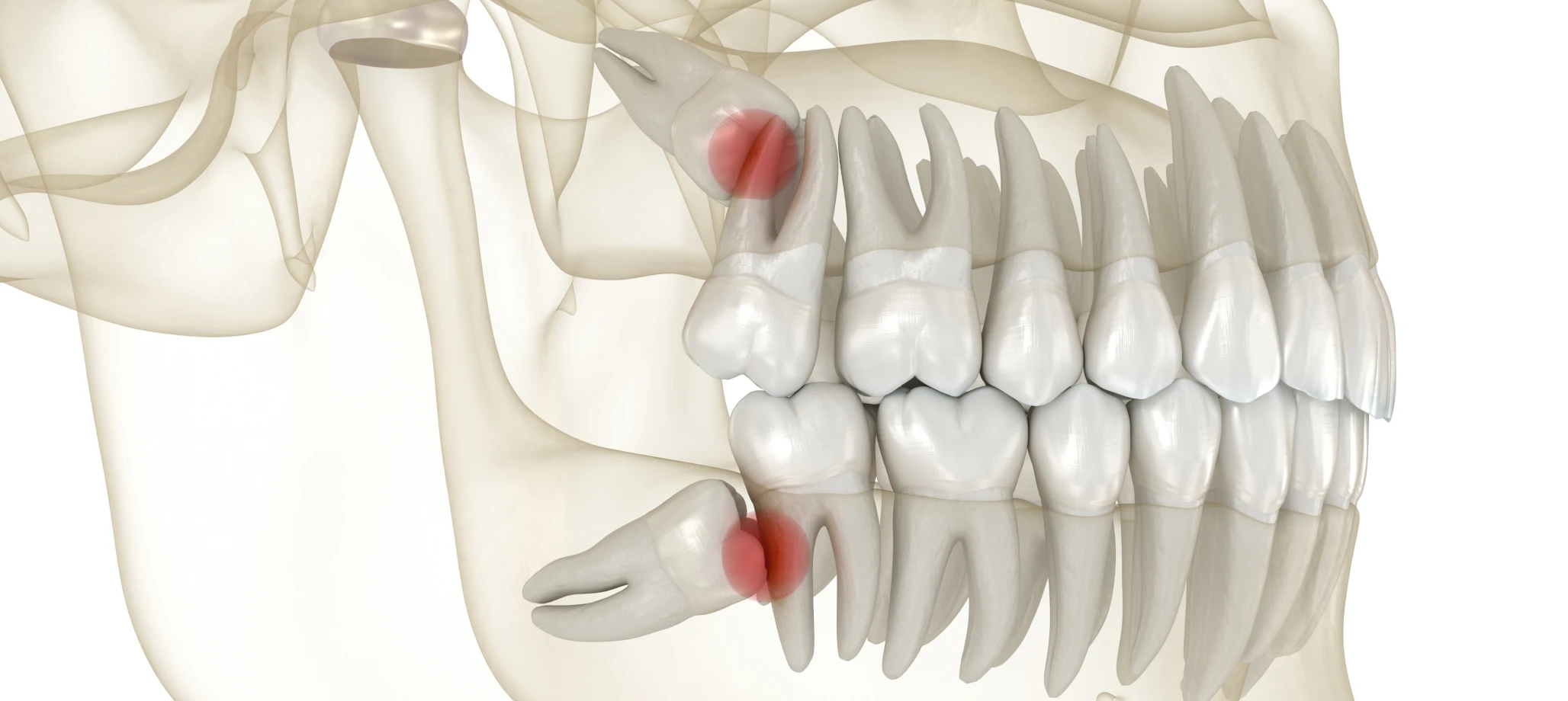 Extraction des dents de sagesse 