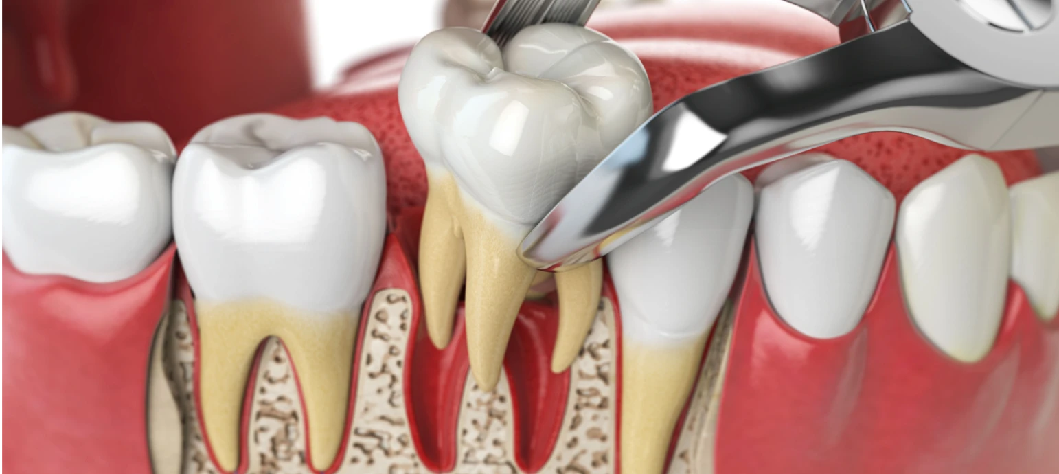 Extraction dent / racine incluse 