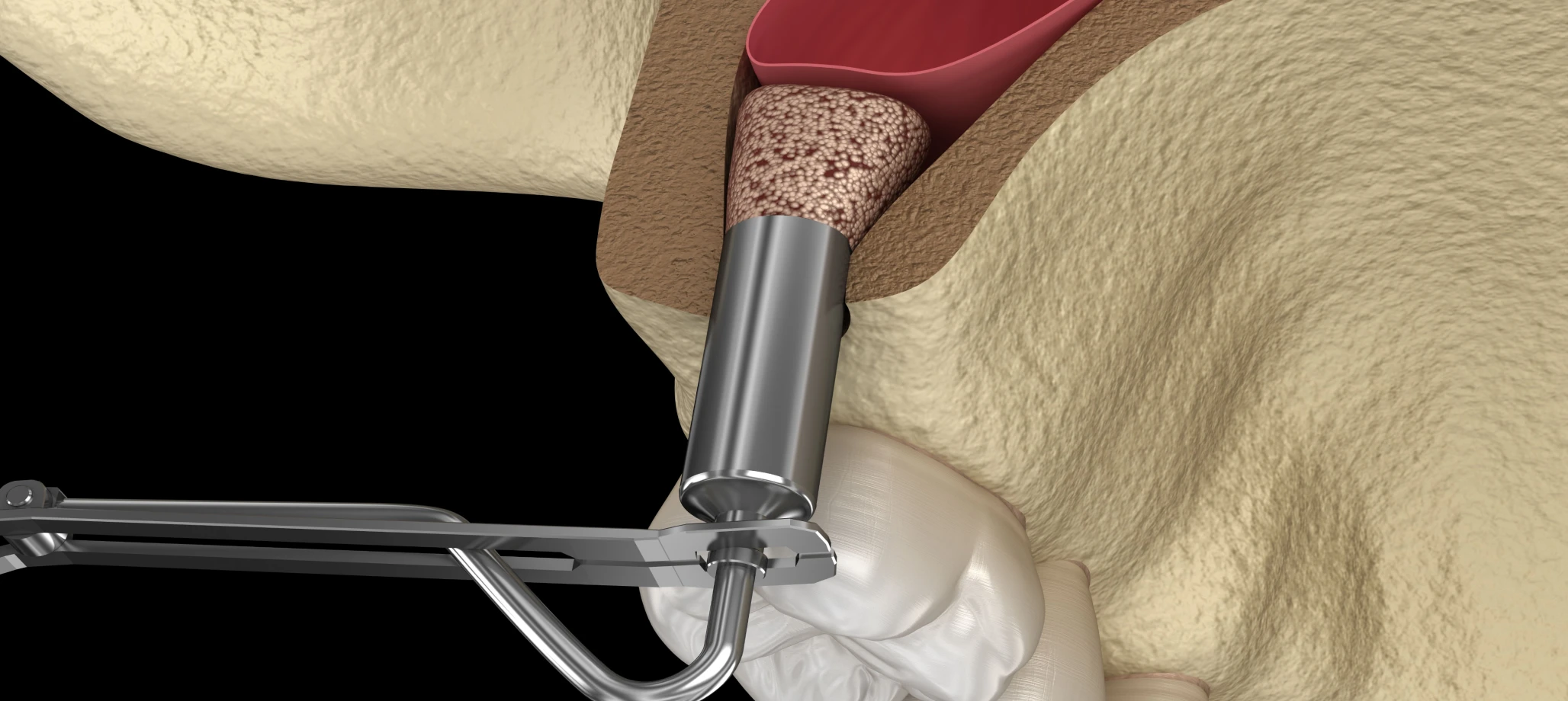 Soulevé de sinus 