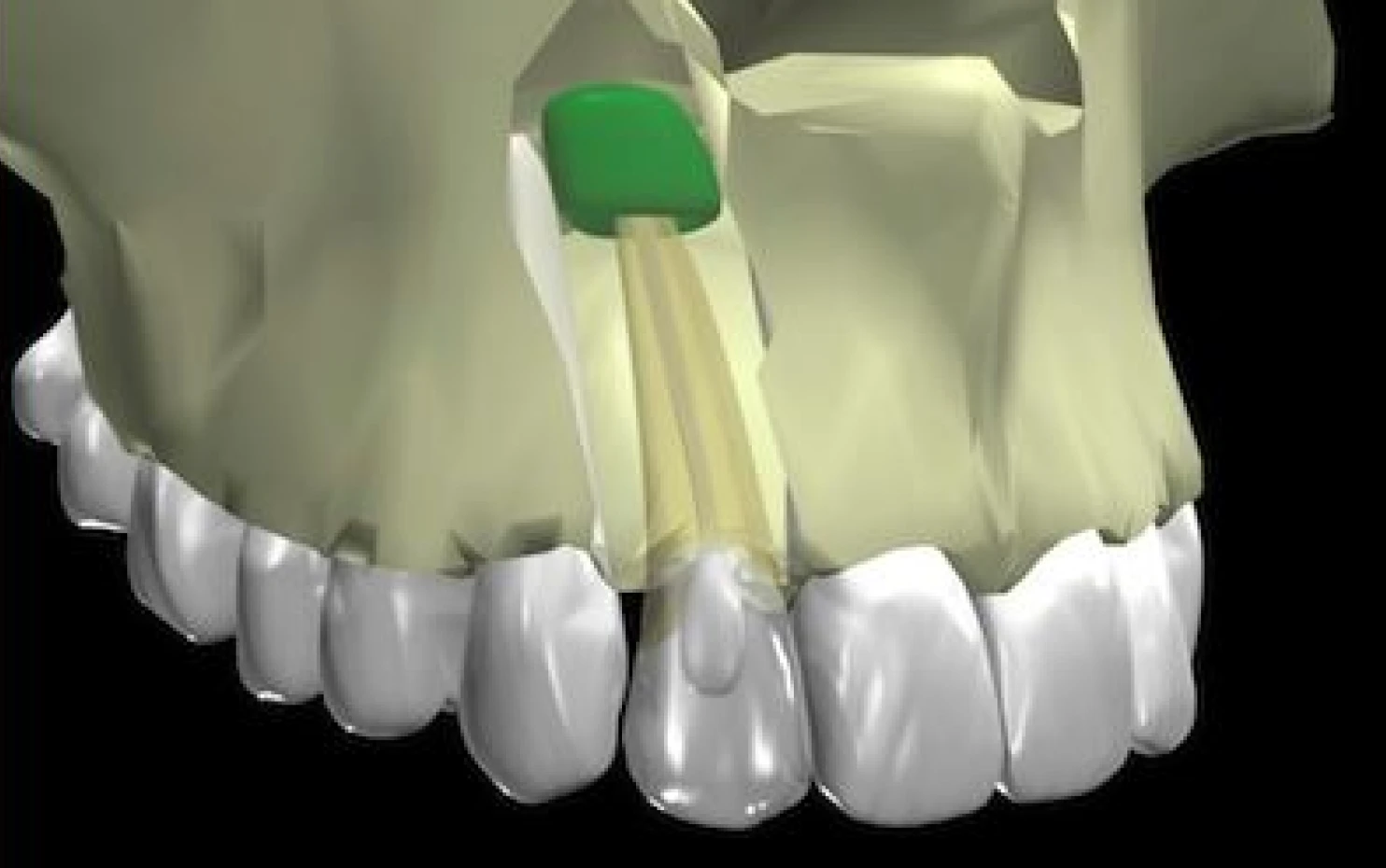 Résection apicale