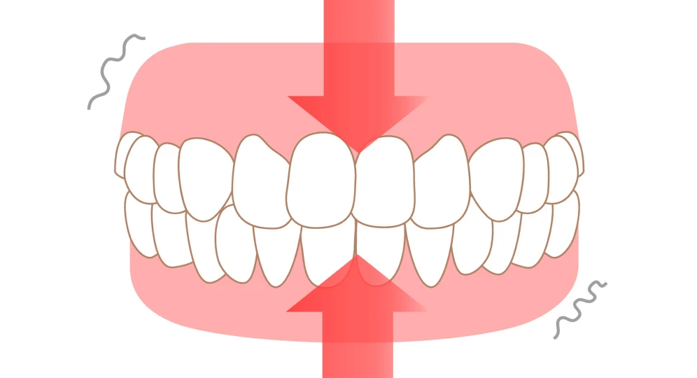 Occlusodontie